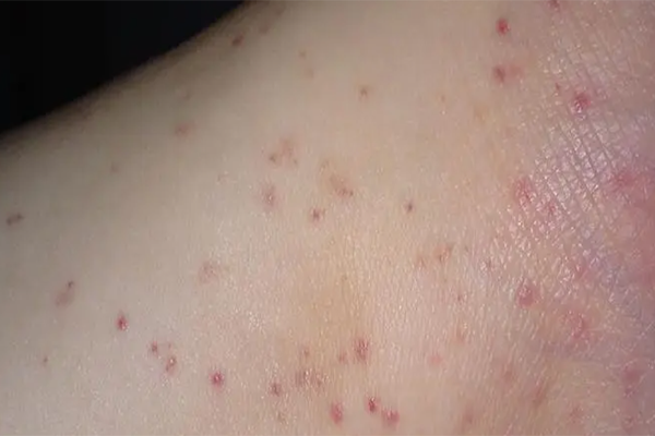 皮肤红疹会对身体造成危害