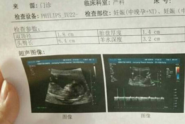 已生男宝妈妈认为孕13周NT数值小于1.6mm是男孩还是女孩，本文将揭晓答案
