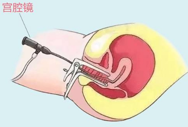 子宫穿孔是宫腔镜手术的并发症