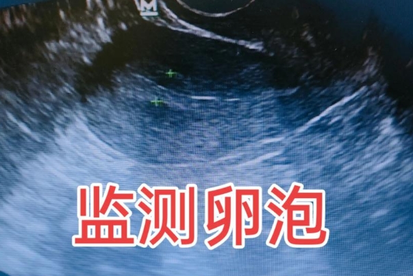 卵泡监测可以查看卵泡发育情况