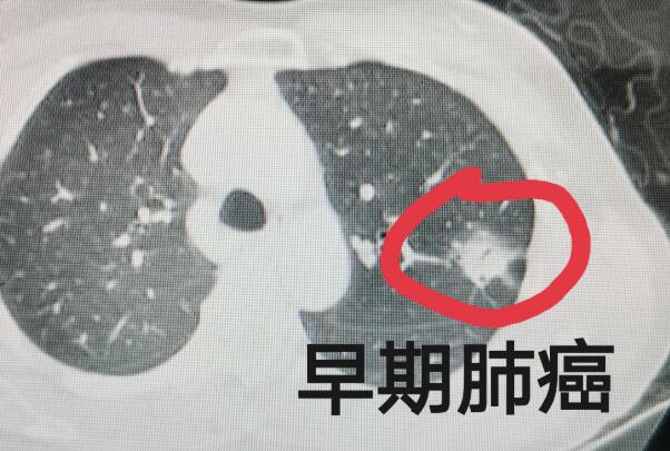 80岁老人肺癌早期没有扩散的情况下一般能活多久？