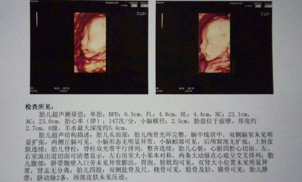 四维彩超单隐藏的地方可以看男孩和女孩吗?
