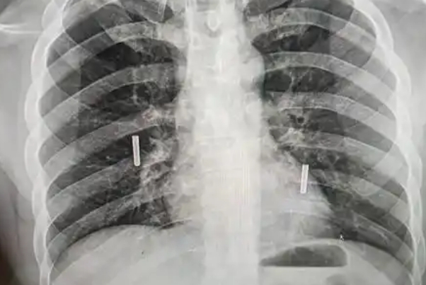拍胸片后建议延缓备孕时间