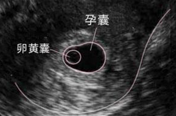 大夫说有卵黄囊胎儿就很好，胚胎存活的“硬指标”