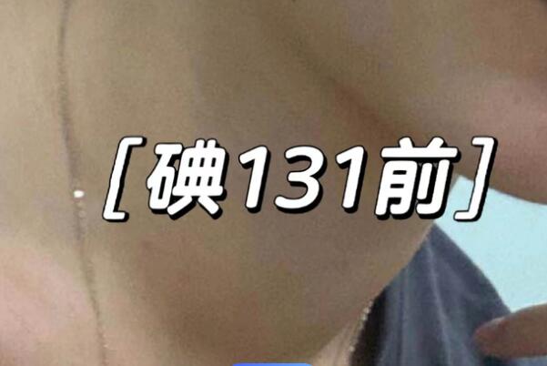 碘131后悔害了我一生，患上甲亢要谨慎选择治疗方法