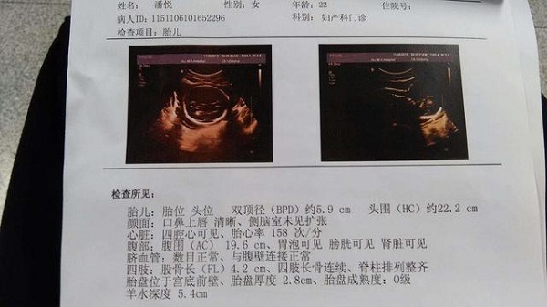 孕妇B超检查单子上的bpdhcacflhl分别是指什么?