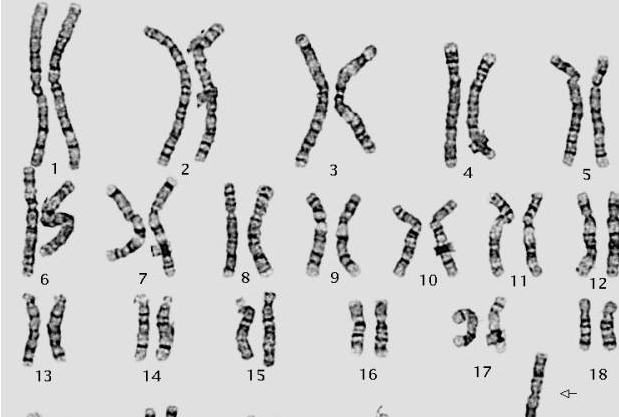2号染色体异常不能自然受孕生孩子可以用3代试管技术来解决吗？
