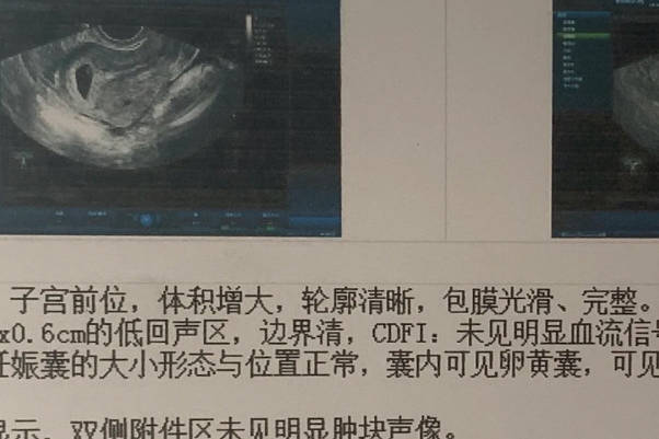 胎心位置判断男女并不准确