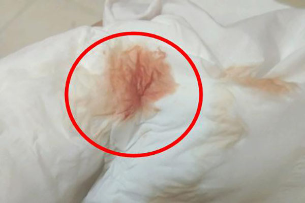 刚怀孕着床出血是什么颜色，有图片参考吗?
