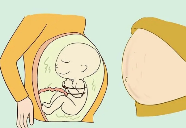 孕四月是脐带绕颈高峰期