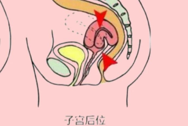 子宫后位特殊的同房姿势有利于怀孕