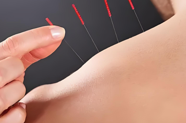试管促排进周后女性还可以做针灸增加卵泡质量吗？