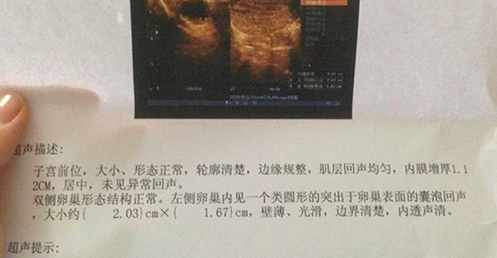 彩超监测卵泡数据更佳直观
