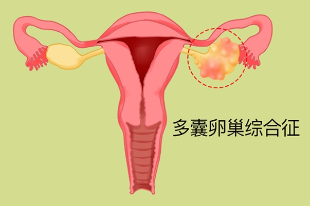 多囊患者先调理后促排会事半功倍