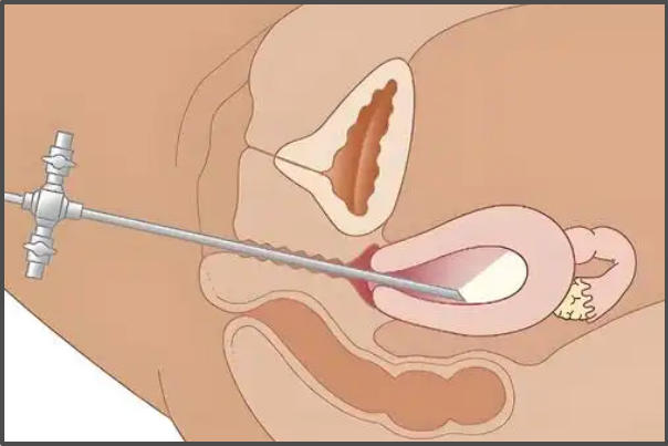 子宫内膜厚度会影响胚胎移植成功率