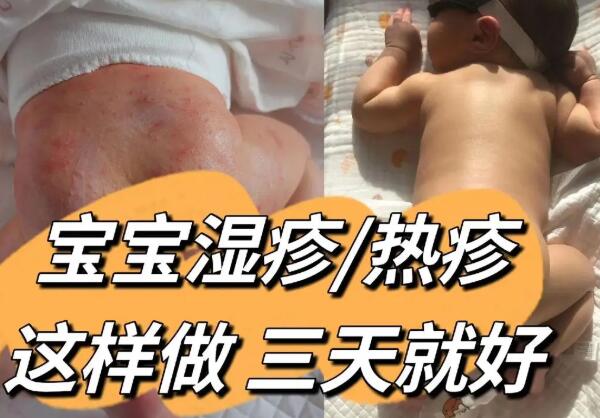 婴儿湿疹和热疹的护理方法有差异