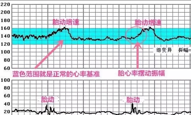 孕晚期正常的胎心监护曲线图是什么样的？