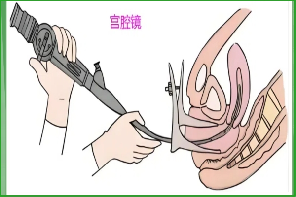 宫腔镜手术后当月是否可以促排看个人情况