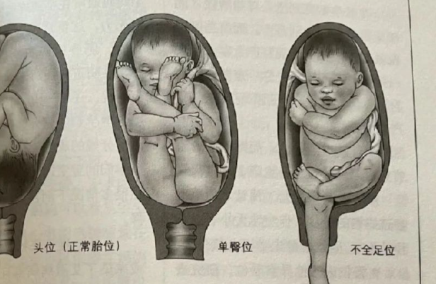 臀位有几种不同的类型