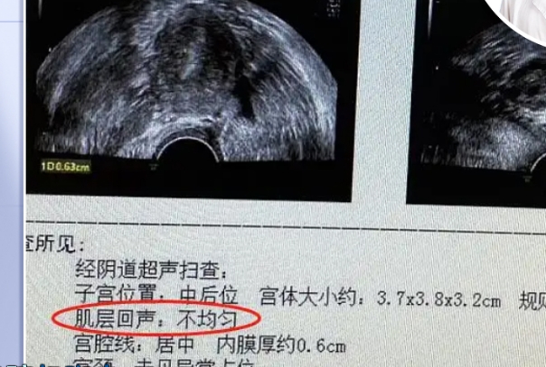 炎症感染会导致子宫内膜不均匀