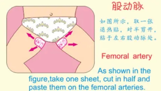 小孩退热贴可以贴腹股沟部位