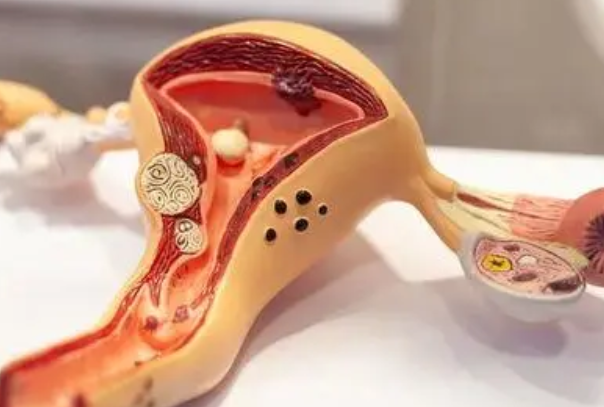 子宫息肉是妇科常见病