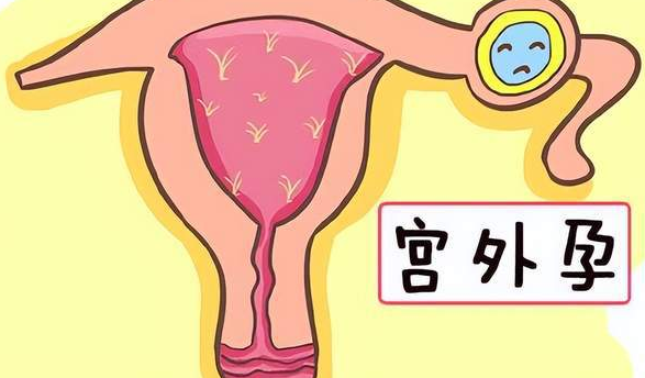 做试管婴儿需警惕宫外孕，一文读懂什么是宫外孕