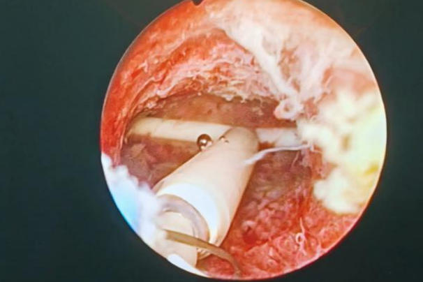 高龄备孕要摘了曼月乐环