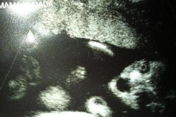 16周b超影像下男宝女宝腿部间的区别是什么，有图片分享吗？