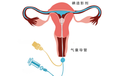 输卵管造影后流血几天算正常？