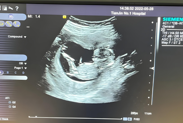 孕12周nt值1.1mm是怀男宝几率大还是怀女宝几率更大？