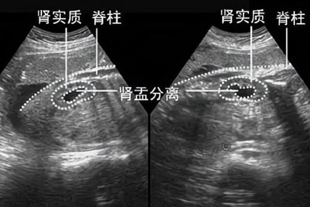 怀女娃也会出现肾盂分离