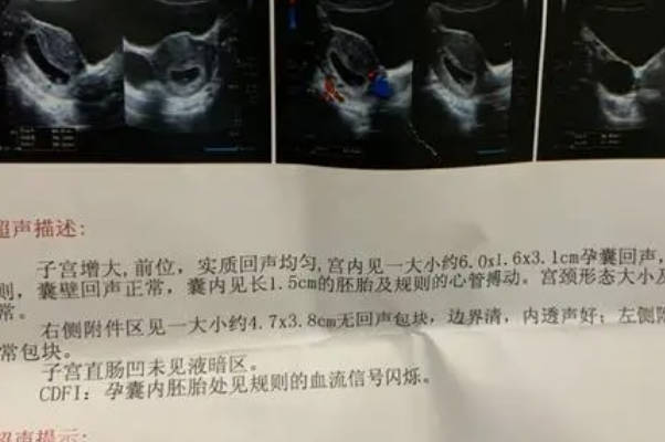 怀男孩孕囊表现为茄子型