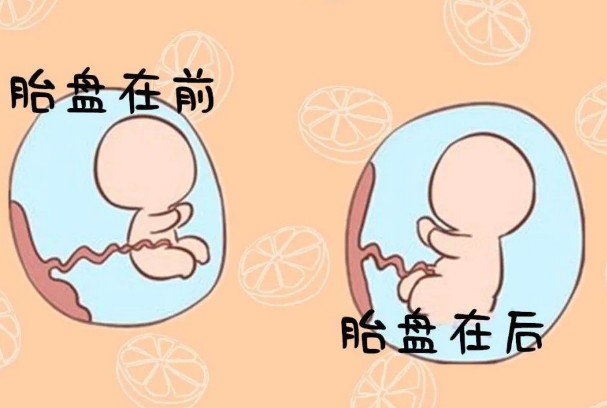 胎盘后壁要比前壁分娩更痛