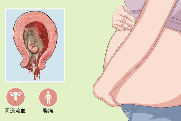 畸精子症会导致流产