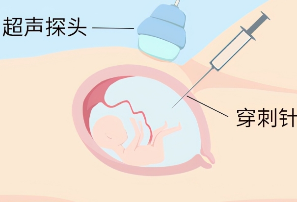 羊水穿刺可以判断胎儿是男是女