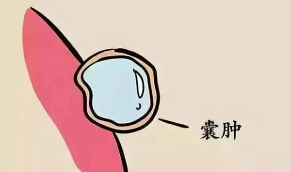 单纯囊肿5厘米能做三代试管