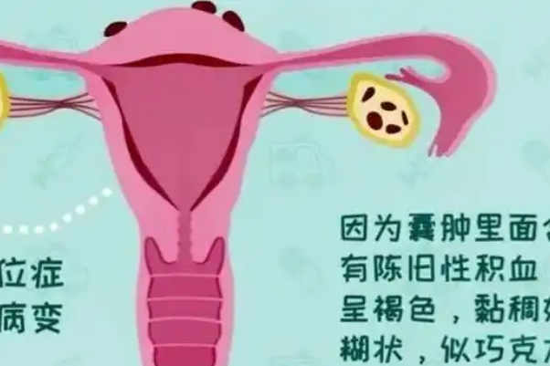 巧克力囊肿试管适合哪种方案，微刺激、拮抗剂等都还行