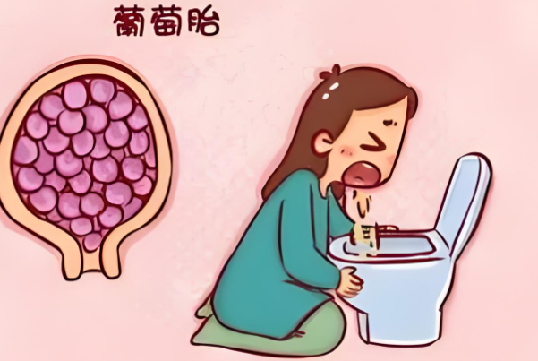 完全性葡萄胎是三代试管基因筛查的指征吗？