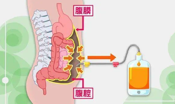 腹膜透析是一种慢性疾病管理手段