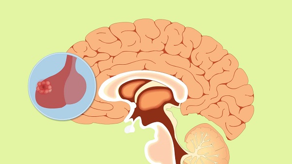 脑垂体瘤的10个征兆分享，第一个是视力严重模糊