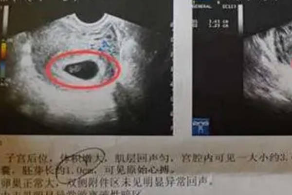 囊胚移植46天后出现空孕囊没有胎心胎芽的几率有多大？
