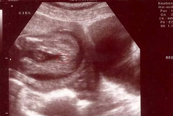孕妈妈们如何通过彩超检查看出是男孩女孩？