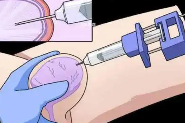 精子质量会影响取精时间