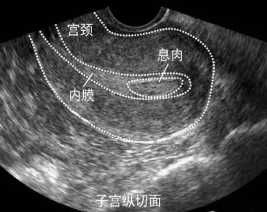 小的内膜息肉影响试管移植吗？有息肉能不能移植？