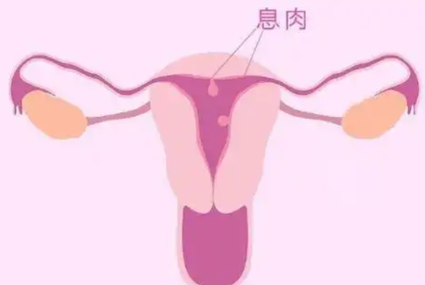 多发子宫内膜息肉做试管成功的案例多吗？