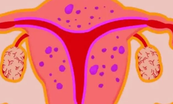 子宫腺肌症严重程度揭秘，易引发女性不孕现象