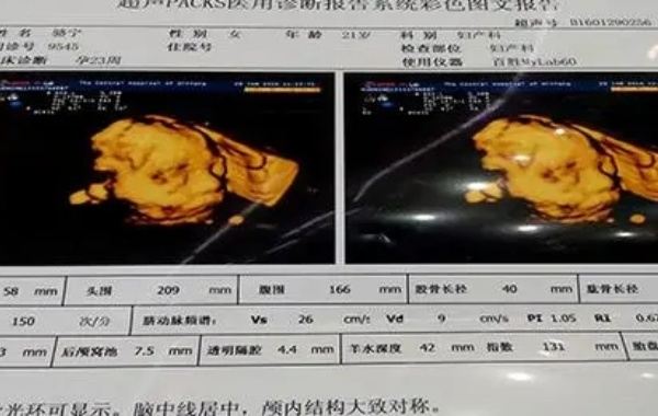 孕24周做四维提示双肾未见分离一般是男孩还是女孩呢？