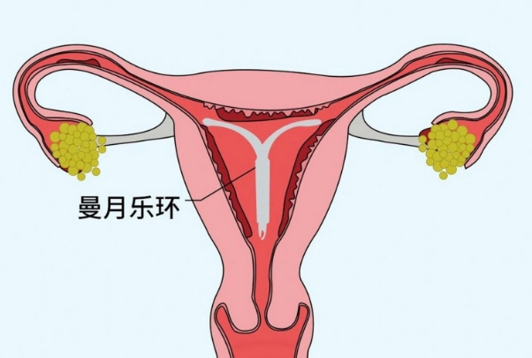 43岁的高龄女性想要正常备孕是要先去医院摘曼月乐环吗？