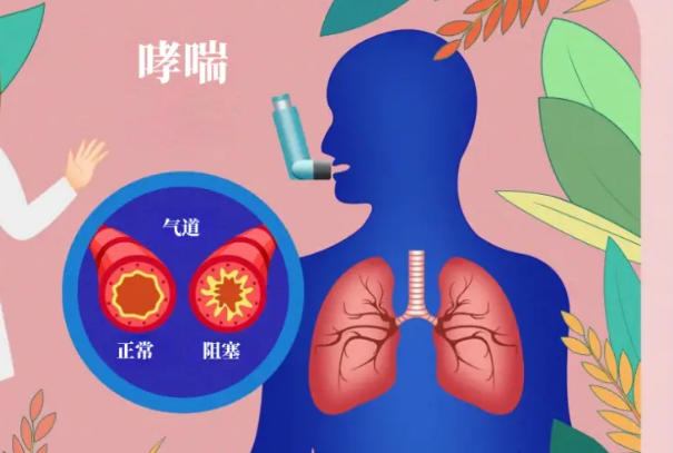 试管婴儿有得哮喘的风险